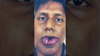 Hemangioma of lip and tongue and cheek treated with laser and surgery [upl. by Menzies]