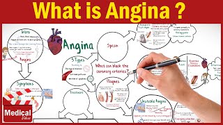 Pharmacology CVS 16 What is Angina Pectoris  Types of Angina Symptoms Causes and Treatment [upl. by Lasser266]