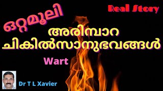 How to Remove Warts from Skin at Home  Home Remedies  Dr T L Xavier Ayurveda Sharing Experience [upl. by Nylaehs598]