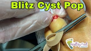 Popping a Ganglion Cyst [upl. by Giles]