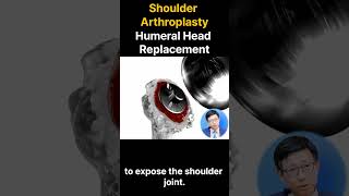 Shoulder arthroplasty  Humeral Head Replacement [upl. by Neille]