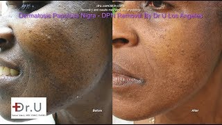 Best Dermatosis Papulosa Nigra Removal in Los Angeles [upl. by Assirram543]