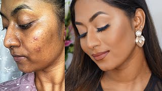 HOW TO COVER ACNE PRONE SKIN amp HYPERPIGMENTATION ✨  Flawless Full Coverage Base [upl. by Fallon]