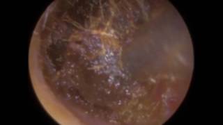 50 years worth of Ear Wax Removed  Mr Neel Raithatha The Hear Clinic [upl. by Amian494]