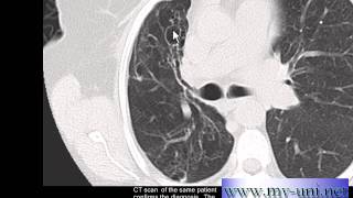 Chest xray Bronchiectasis on CT and Chest xray [upl. by Ennagroeg]