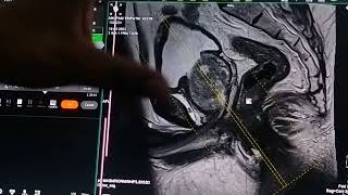 MRI PROSTATE SCANNING INTERPRETATION [upl. by Goddard785]