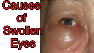 How to Cure Swollen Eyes Overnight  You Wont Believe The Results [upl. by Brause474]