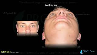 Orthognathic Jaw surgery amp oral and maxillofacial surgery using CT 3D imaging [upl. by Alekahs]