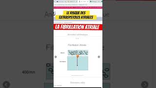 Risque des extrasystoles atriales  la fibrillation atriale  rythmologie [upl. by Aubrey]