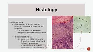 Chondrosarcoma [upl. by Giannini]