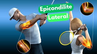 EPICONDILITE LATERAL OU TENIS ELBOW  Dr Prof Nelson Marques [upl. by Fleta]