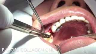 Ridge preservation  BioOss Collagen only No membrane coverage [upl. by Gerhan241]