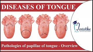 Diseases of tongue  Pathologies of papillae of tongue  Overview  Tongue diseases  Oral Pathology [upl. by Noiro933]