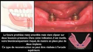 Prothèse amovible et implants dentairesMandibular overdentures [upl. by Chemesh]