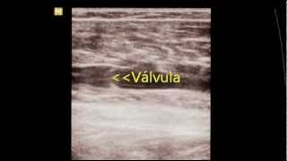 MEDIPEDIA Doppler Varizes ultrassonografia [upl. by Leahkim]