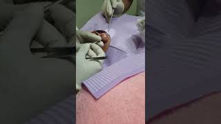 Surgical removal of a large earlobe cyst surgery pimple popper timelapse video [upl. by Norej]