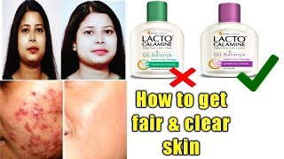 Lacto Calamine lotion reviewusesbenefitshow to get clear and fair skin [upl. by Adnohsak]