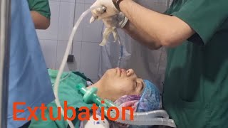 how to extubate patient after surgery Deep extubation [upl. by Binnings862]