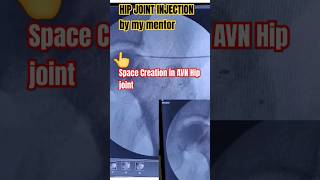 HIP JOINT INJECTION [upl. by Clevie]