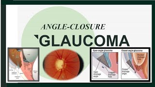 Closed Angle Glaucoma Acute amp Chronic [upl. by Ailicec894]