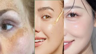 Remove Pigmentations झाइयां Dark Spot How to treat pigmentation [upl. by Akvir]