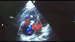 Right ventricular dualthrombi attaching to the chordae tendineae a case report [upl. by Enelehcim]