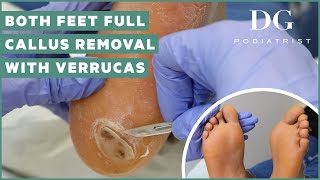 Callus removal from feet both feet and three verruca plantar warts treatment [upl. by Goodrich650]