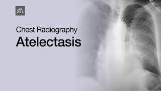 Chest Radiography Atelectasis [upl. by Delastre]