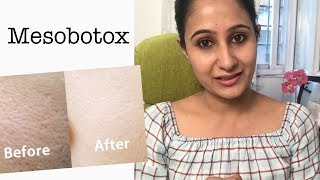 Mesobotox for open pores and smoother skinमेसो बॉटॉक्स [upl. by Reinal128]