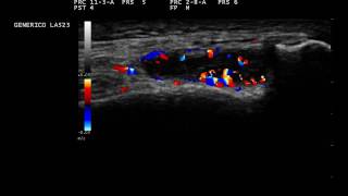 Knee Synovitis Ultrasound [upl. by Einnad]