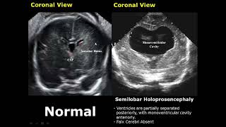 Fetal Brain Ultrasound Normal Vs Abnormal Image Appearances Comparison  Fetal Brain Pathologies USG [upl. by Etnoved948]