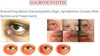 DACRYOCYSTITIS Sign Symptoms Causes Risk factors Treatment [upl. by Selia]