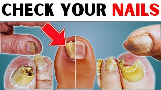 17 Nail signs of Health Problems Diseases and their Nutritional deficiencies [upl. by Barth]