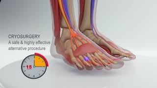 Heeling Mortons Neuroma with Minimally Invasive CryoSurgery Procedure [upl. by Ecam]