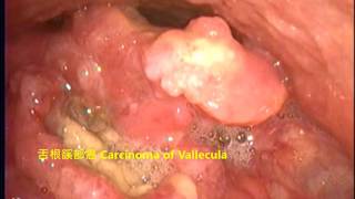 口咽癌、上喉癌、聲帶結節 Carcinomas of oropharynx vallecula amp larynx epiglottis vocal nodules [upl. by Gill913]