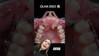 DENTE PRESO NA GENGIVA 😱🦷 shorts [upl. by Ollayos]