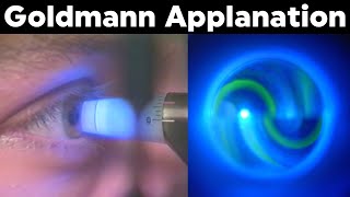 Goldmann Applanation Tonometry Procedure Technique Tutorial [upl. by Dnilasor249]