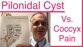 Do you have a PILONIDAL CYST or is it Coccyx Pain Tailbone Pain [upl. by Ainniz]