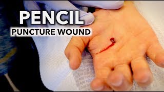 HE STABBED HIS HAND WITH A PENCIL puncture wound  Dr Paul [upl. by Corsiglia645]