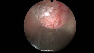 23018 Electrofulguration of trigonitis in the management of recurrent urinary tract infections [upl. by Halda]