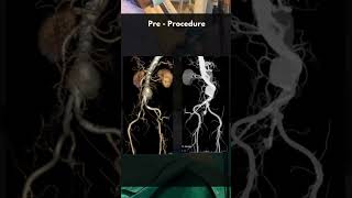 EVAR Procedure By Dr Bhavesh Arun Popat [upl. by Aseram]