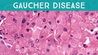 Gaucher disease involving bone lysosomal storage disorder glucocerebrosidase deficiency pathology [upl. by Anitnatsnok]