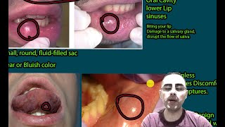 Bump in the mouth Mucocele Submucosal Cysts signs symptoms and treatment [upl. by Acirdna109]