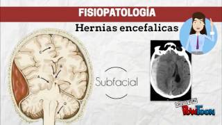 Fisiopatología de los tumores cerebrales [upl. by Hauser816]