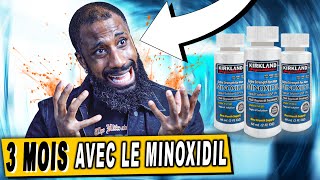 3 mois avec le MINOXIDIL pour ne plus avoir de CALVITIE [upl. by Ditter533]