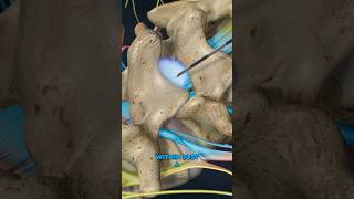 Lumbar Epidural Steroid Injection 3D Animation [upl. by Machute]