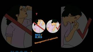 Management of epistaxis nosebleed epistaxis orthopedics mbbs [upl. by Hpsoj30]