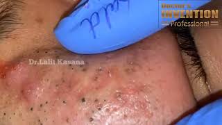 BLACKHEADS REMOVAL BY DR LALIT KASANA [upl. by Ettegirb734]