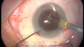 IOL exchange  Oculentis explantation and Panoptix implantation [upl. by Anissa]