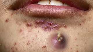 Big Cystic Acne Blackheads Extraction Blackheads amp Milia Whiteheads Removal Pimple Popping  1338 [upl. by Schroer752]